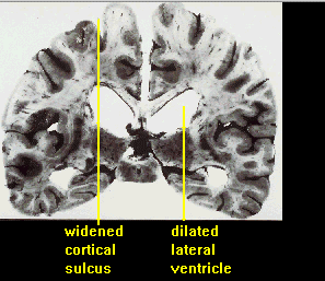 Erweiterte Sulci und Ventrikel1.gif (35878 bytes)